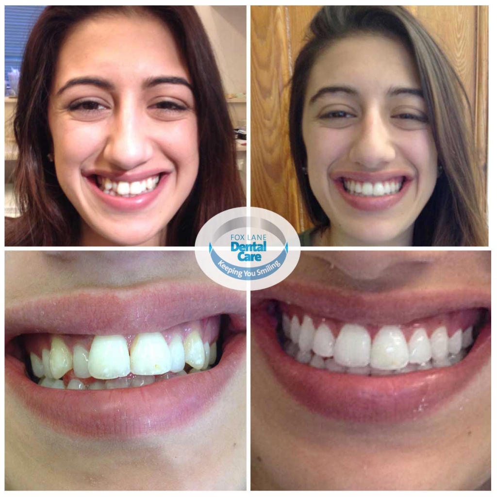 Before and after of orthodontic treatment and smile ...