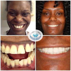 Before and after of orthodontic treatment and smile makeovers