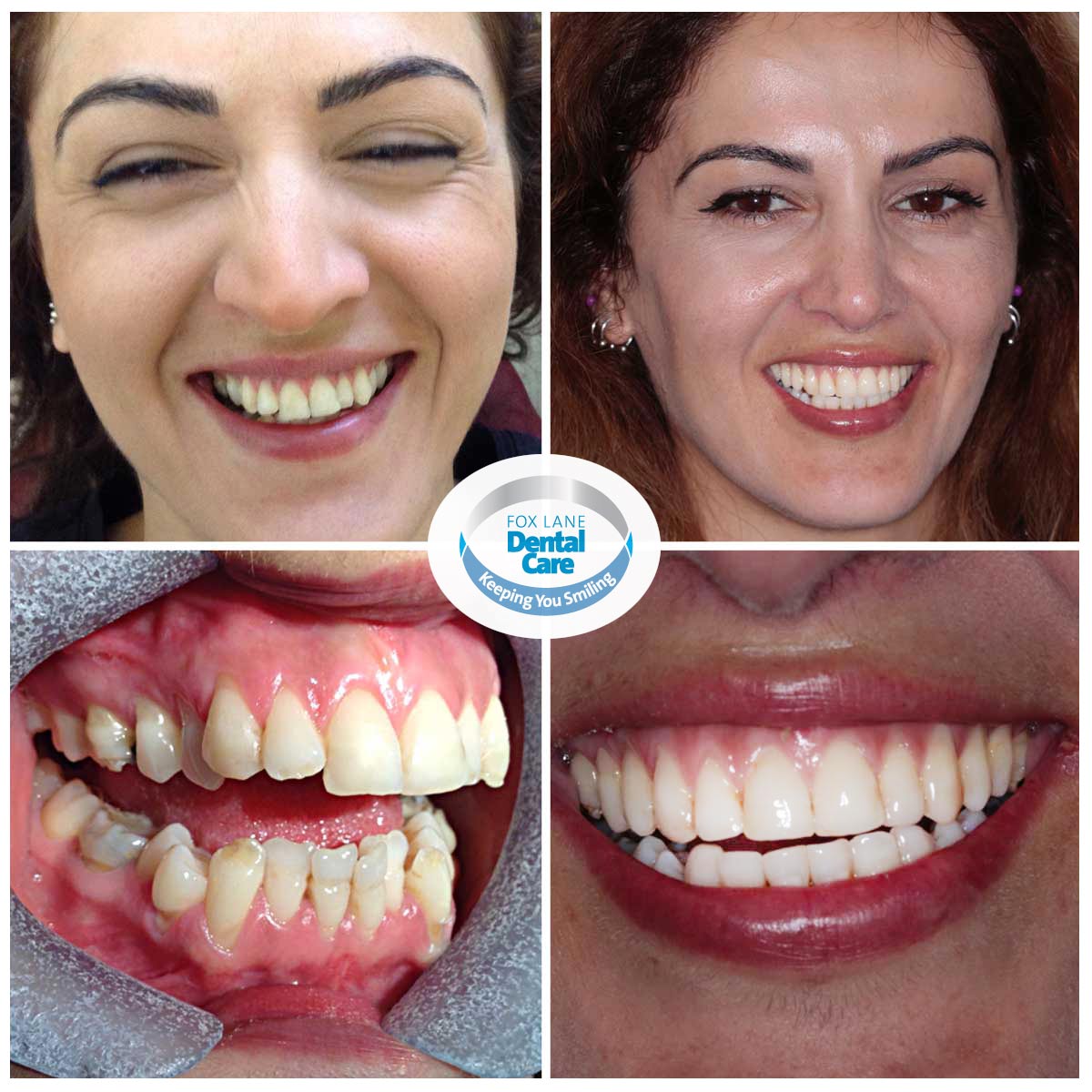 3-before-after-orthodontics-smile-makeovers - Fox Lane ...