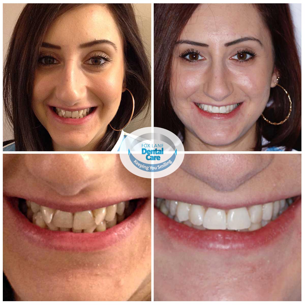 4-before-after-orthodontics-smile-makeovers - Fox Lane ...