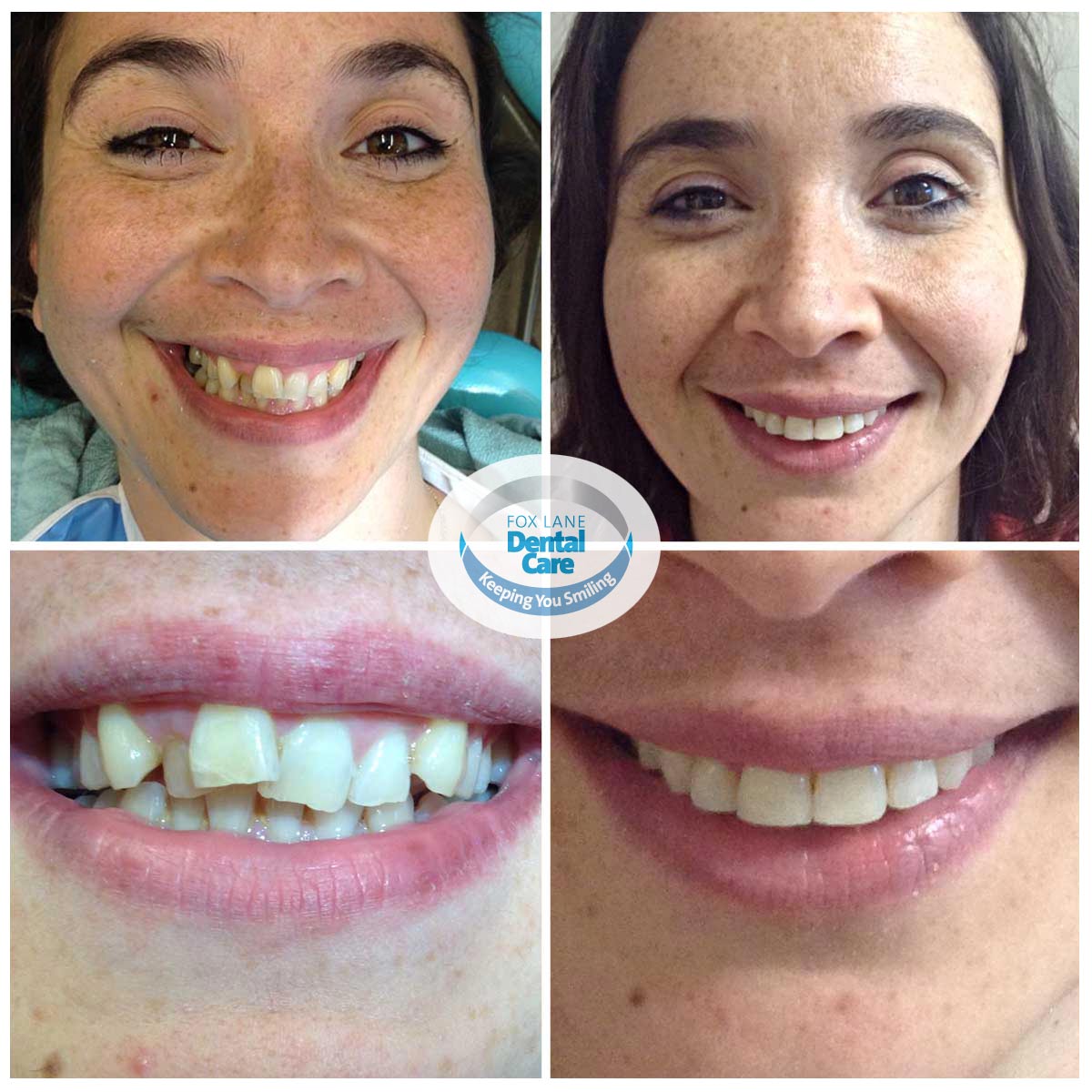 See the gallery of before and after Orthodontic treatment and smile makeovers by Fox Lane Dental Care.