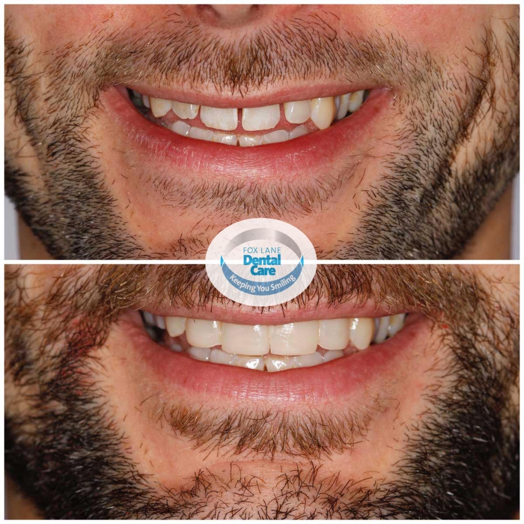 Before and after of orthodontic treatment and smile ...